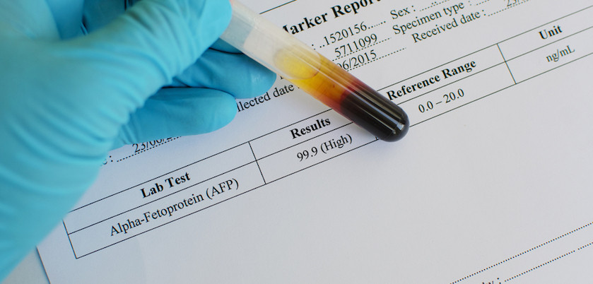 Tripl test - prenatalna dijagnostika trizomije i određenih defekata
