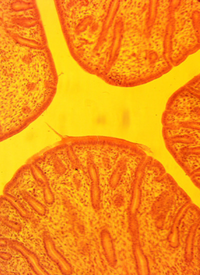 Adenomioza - endometrioza zidova materice