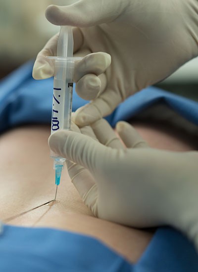 Epiduralna anestezija - da ili ne?